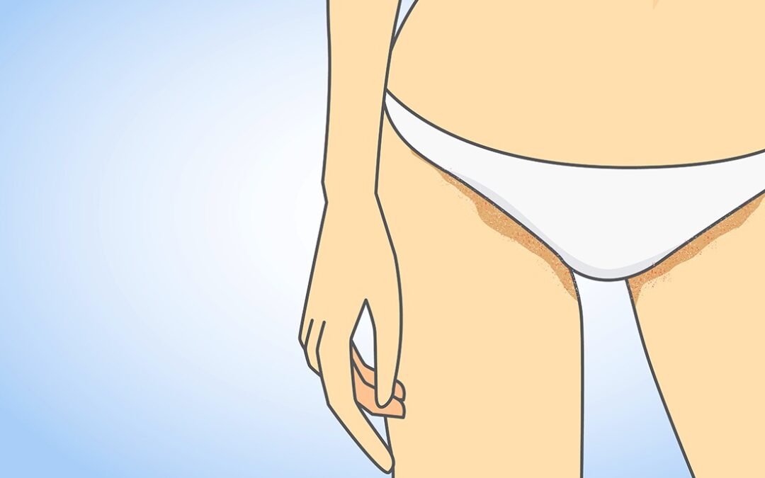 Como identificar e tratar micose na virilha?