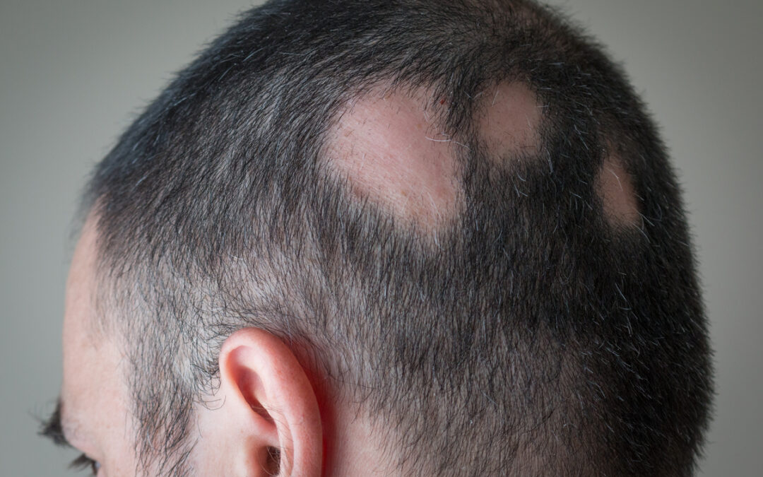 Alopecia areata