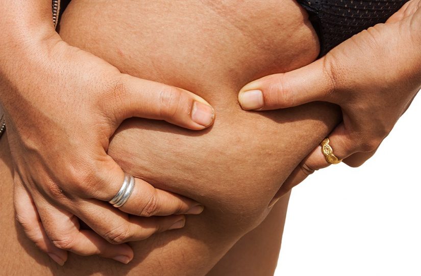 Como acabar com a celulite?