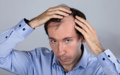 Calvície genética: será que eu tenho?
