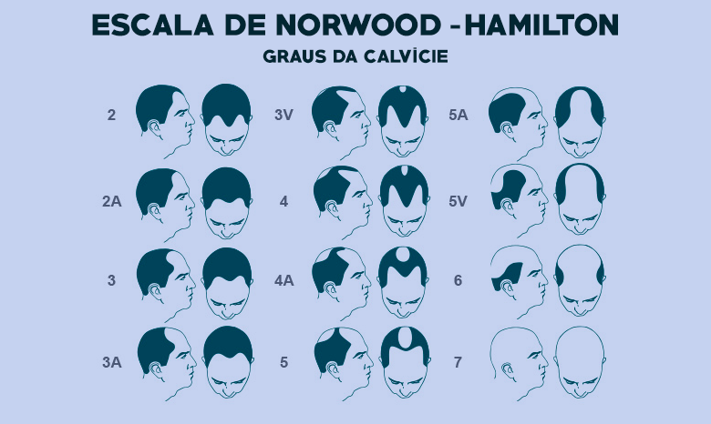 Escala de norwood hamilton