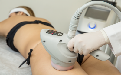 Celulite e radiofrequência: antes e depois do tratamento