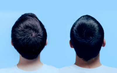 Redemoinho no cabelo: por que ele acontece?