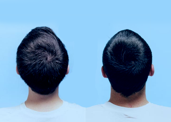 Redemoinho no cabelo: por que ele acontece?
