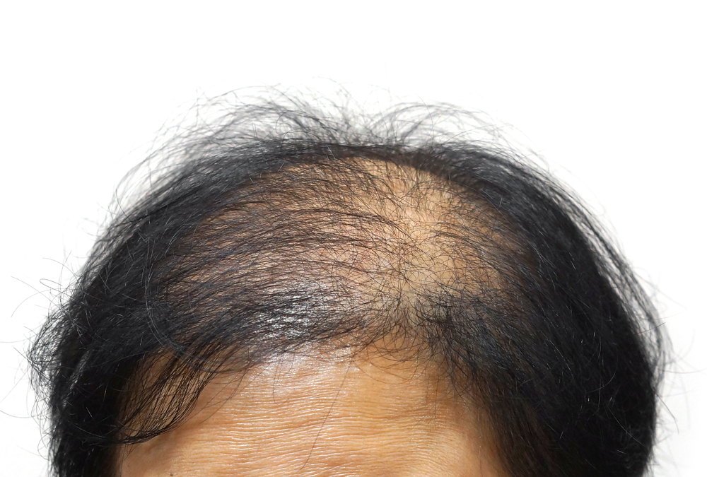 Alopecia androgenética: o que é e como tratar?