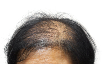 Alopecia androgenética: o que é e como tratar?