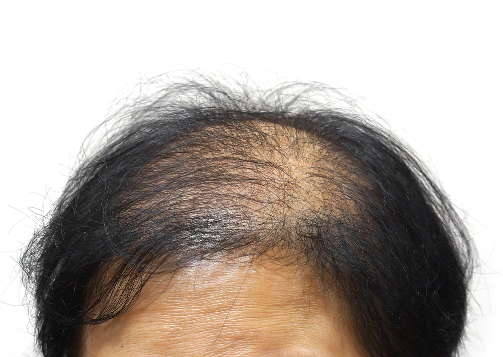 Alopecia androgenética