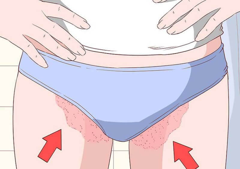 O que são essas manchas na virilha?