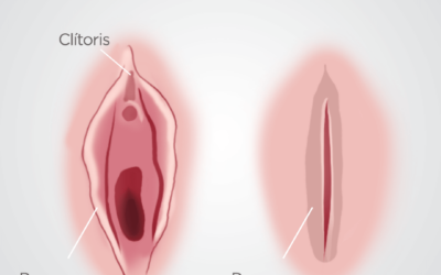 Fimose feminina: o que é e como acontece?
