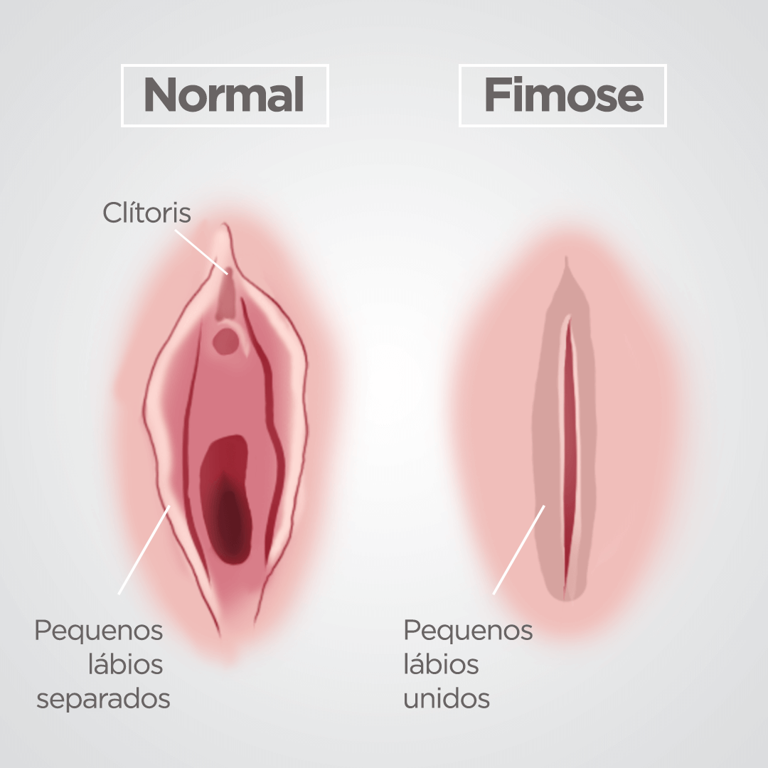 fimose feminina