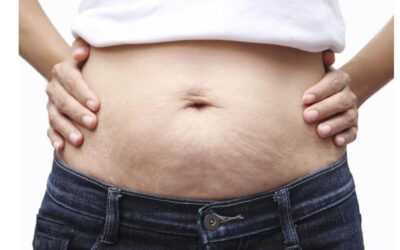 Celulite na barriga: qual é o melhor tratamento?
