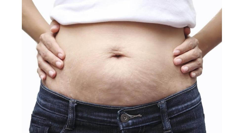 Celulite na barriga: qual é o melhor tratamento?