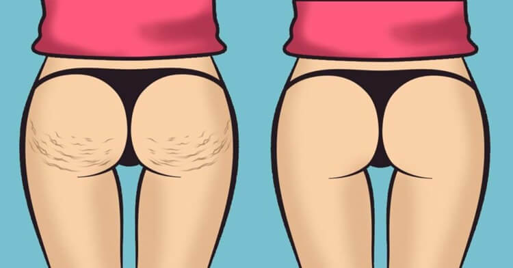 Com quantos anos aparece a celulite?