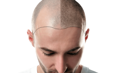 Micropigmentação capilar é uma boa alternativa para a calvície?