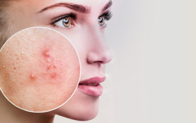 Tratamento de acne é mais rápido com laser