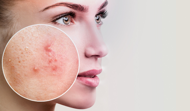 Tratamento de acne é mais rápido com laser
