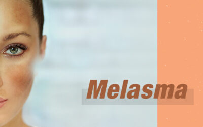 Melasma e Luz intensa pulsada