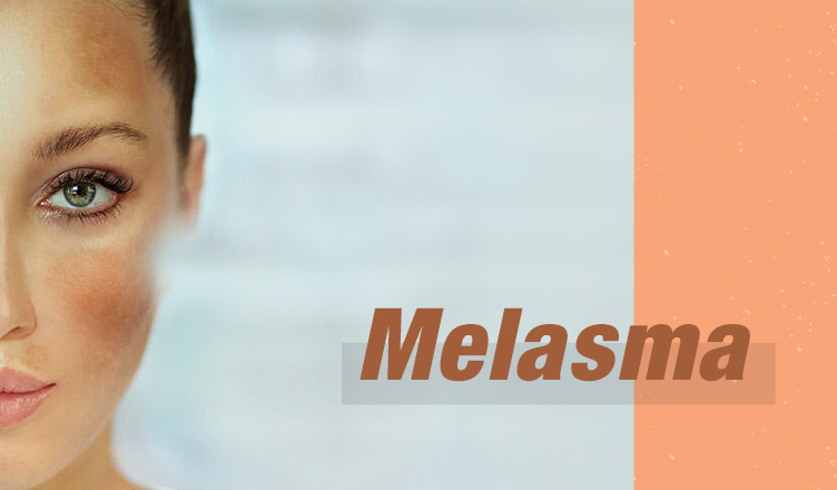 Melasma e Luz intensa pulsada