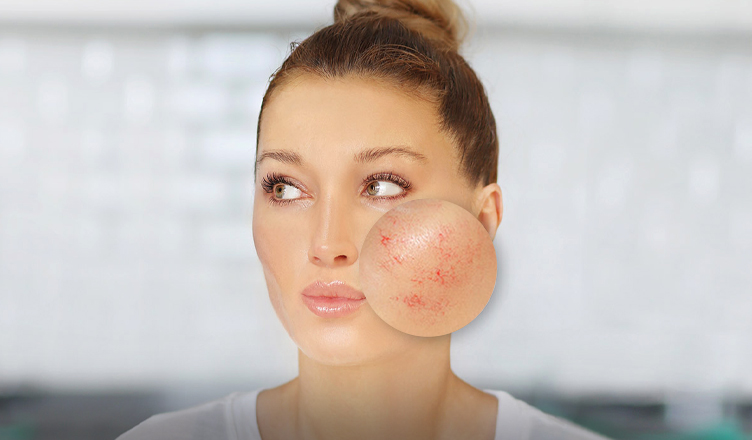 Telangiectasia: saiba tudo sobre os vasos avermelhados no rosto