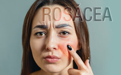 Rosácea: por que aparece e como tratar?