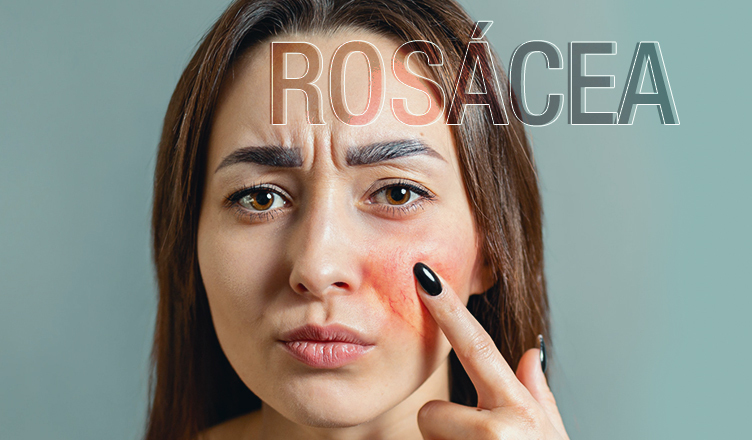 Rosácea: por que aparece e como tratar?