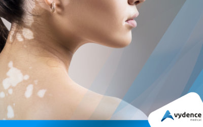 Pele com vitiligo: atente-se a alguns cuidados essenciais