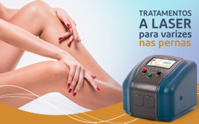 Varizes: tratamentos com laser proporcionam segurança e eficiência