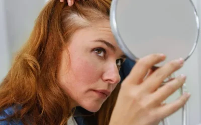 Alopecia: saiba como tratar a perda anormal de cabelos e pelos